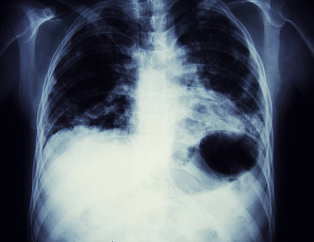 raggi x di un affondo cancro - human lung asthmatic x ray human internal organ foto e immagini stock