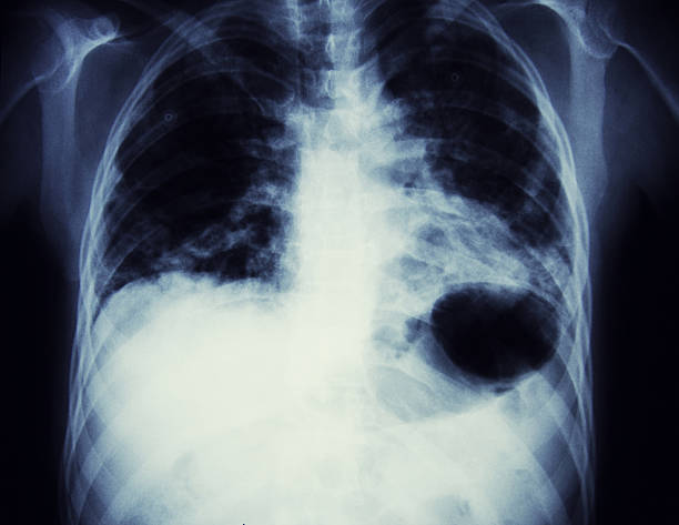 x-ray z przysiadu. raka - human heart x ray image anatomy human internal organ zdjęcia i obrazy z banku zdjęć