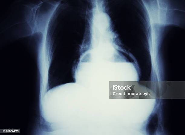 Ernia Dello Stomaco - Fotografie stock e altre immagini di Immagine a raggi X - Immagine a raggi X, Addome, Gabbia toracica
