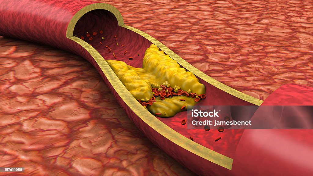 Clogged Artery Low Angle View (3D) Clogged artery low angled view shown with a cut out section displaying fat deposits and a formed clot. High quality rendering with original hand painted textures and global illumination with great detail. Cholesterol Stock Photo