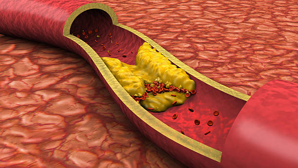 Clogged Artery Low Angle View (3D) Clogged artery low angled view shown with a cut out section displaying fat deposits and a formed clot. High quality rendering with original hand painted textures and global illumination with great detail. Blood Clot stock pictures, royalty-free photos & images