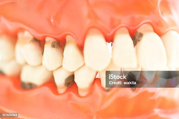 Photo libre de droit de Ensemble De Dents Avec Caries Zähne Karies Macro Image banque d'images et plus d'images libres de droit de Pourrir