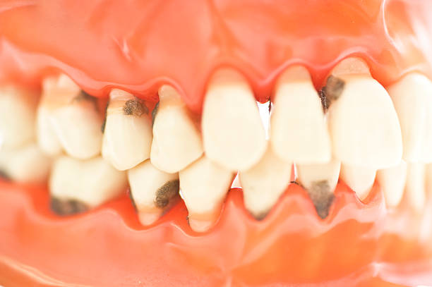 набор зубы с caries макро фото-zähne karies - dentures human teeth stack laboratory стоковые фото и изображения