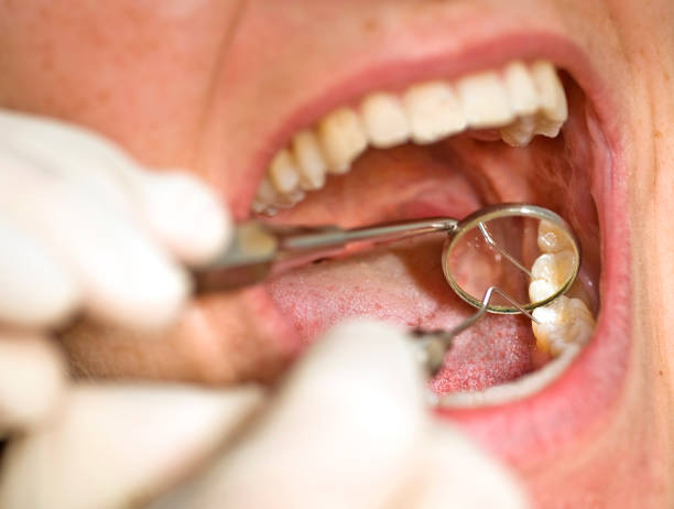 istock Patient at dentist with open mouth during treatment on teeth 157615169