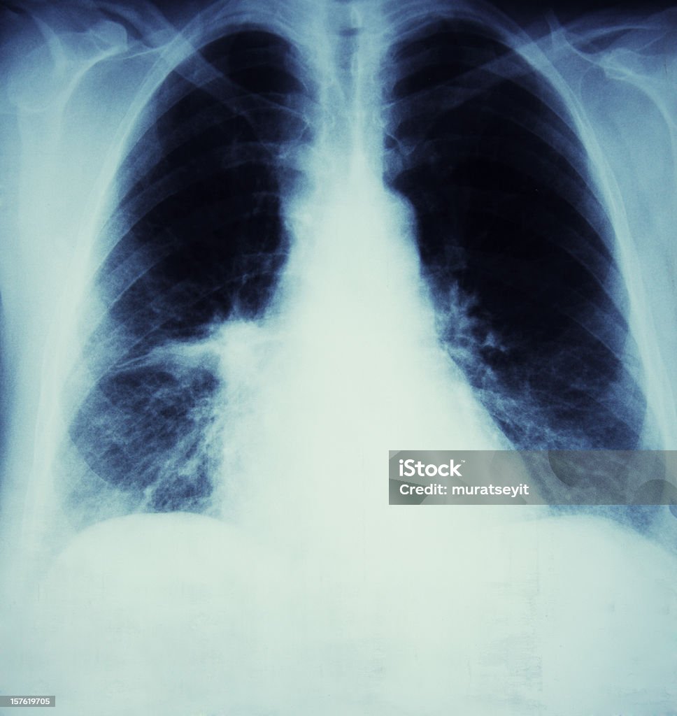 x-ray de un cáncer de la gripe la sala de estar y - Foto de stock de Imagen de rayos X libre de derechos
