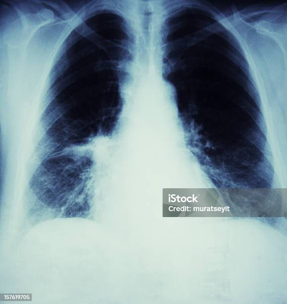 Xray De Un Cáncer De La Gripe La Sala De Estar Y Foto de stock y más banco de imágenes de Imagen de rayos X - Imagen de rayos X, Alvéolo, Cáncer de pulmón