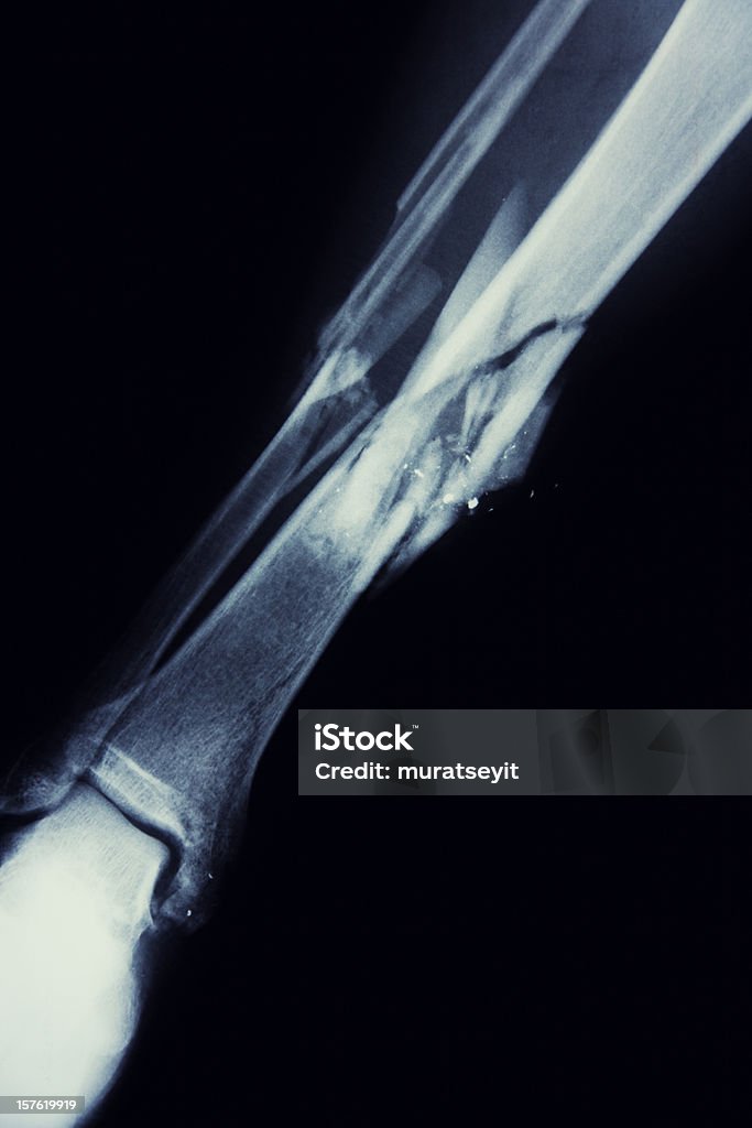 Jambe cassée x-ray par un homme qui automne à l'aube - Photo de Anatomie libre de droits