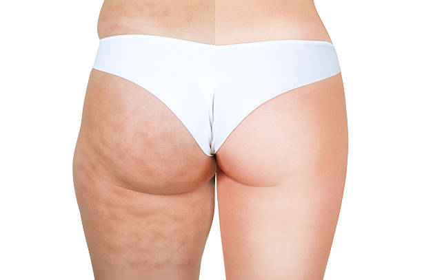 Before and after. Close-up of a female body from behind divided in two parts. cellulite stock pictures, royalty-free photos & images