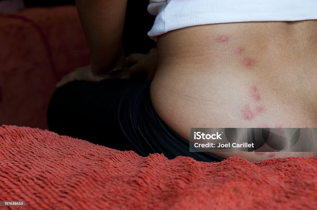 Woman sitting on bed with bedbug bites Itchy bed bug bites on a woman's lower back and buttocks Bedbug Stock Photo