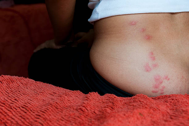 Woman sitting on bed with bedbug bites stock photo