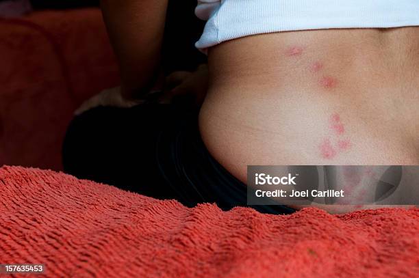 Woman Sitting On Bed With Bedbug Bites Stock Photo - Download Image Now - Bedbug, Biting, Bed - Furniture