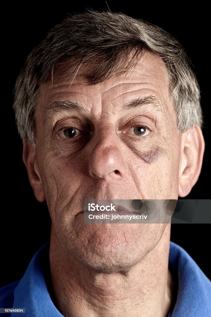 Blackeye. - Royalty-free Face Humana Foto de stock