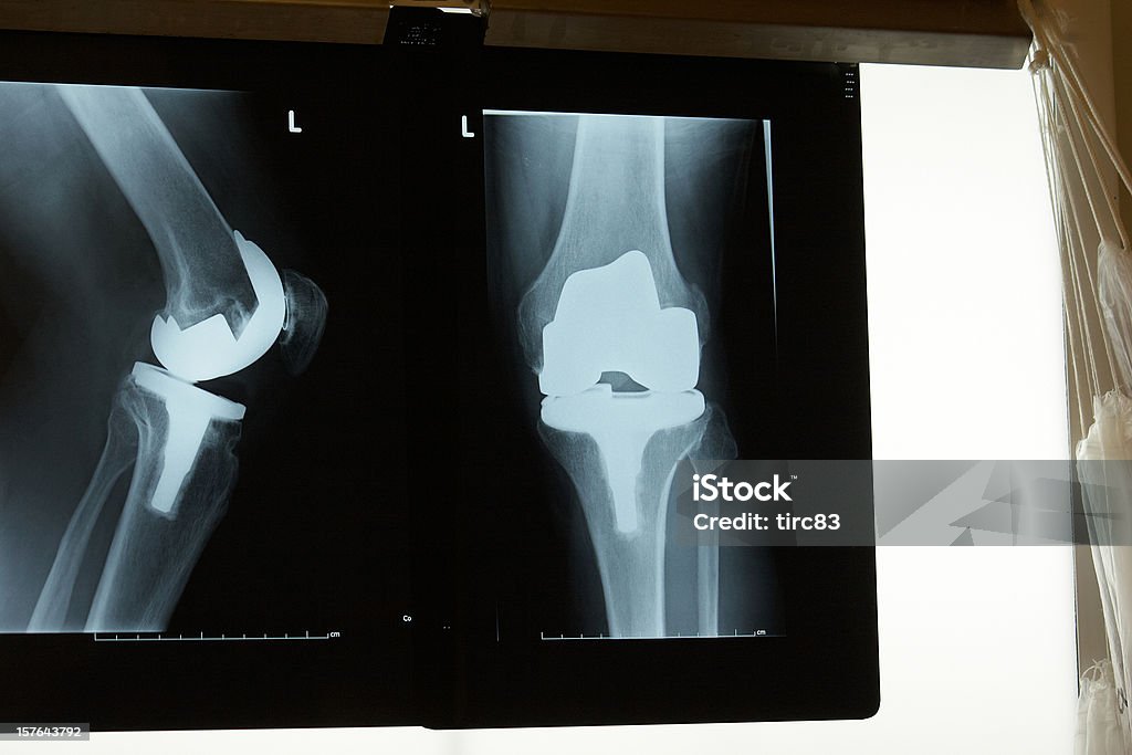 X-ray showing replacement knee joint Back Lit Stock Photo