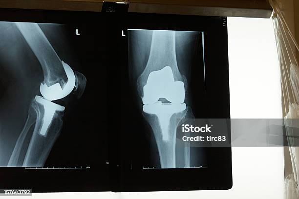 Xray Showing Replacement Knee Joint Stock Photo - Download Image Now - Back Lit, Black And White, Data