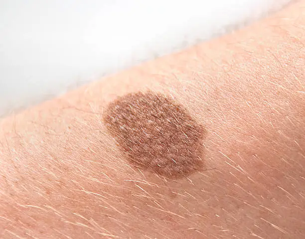 big brown mole on human skin