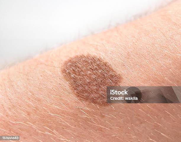 Foto de Mole Mancha De Fígado Birthmark Na Pele Humanaleberfleck e mais fotos de stock de Pinta