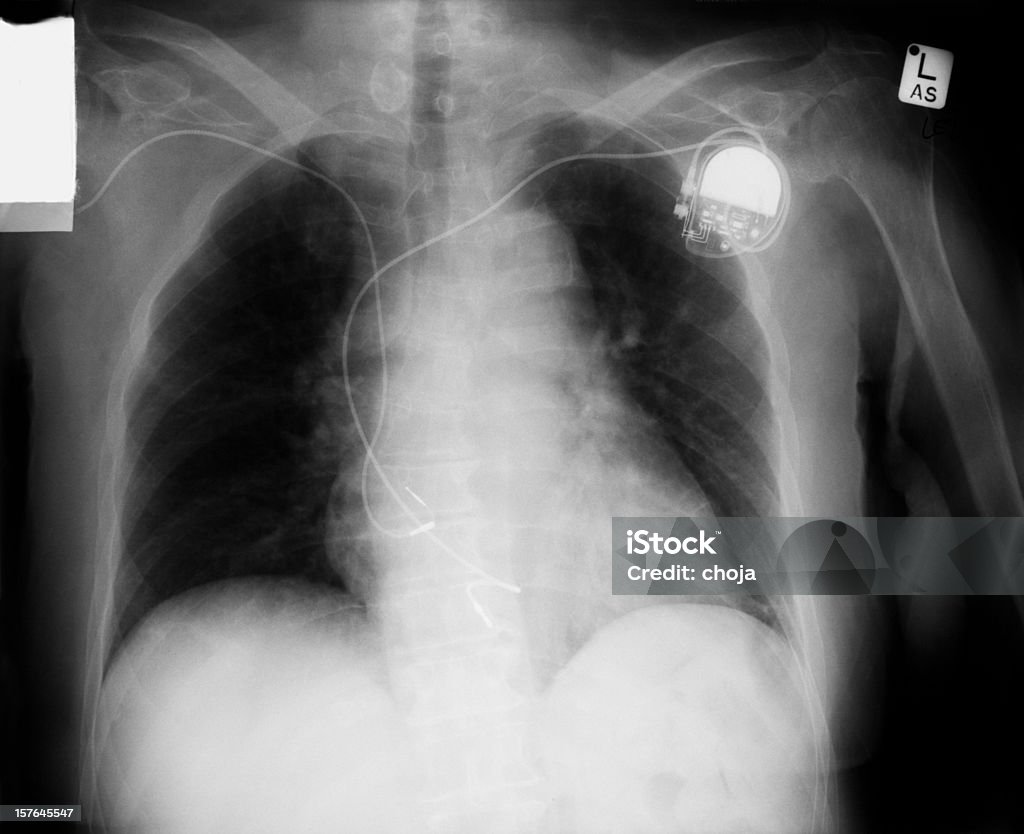 흉부 X-레이, 박동조율기 on - 로열티 프리 심박 조율기 스톡 사진