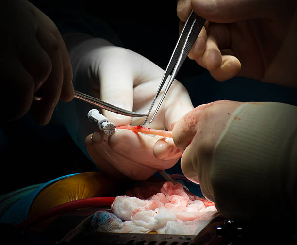 istock Heart Surgery - Vein Graft Preparation 157646228