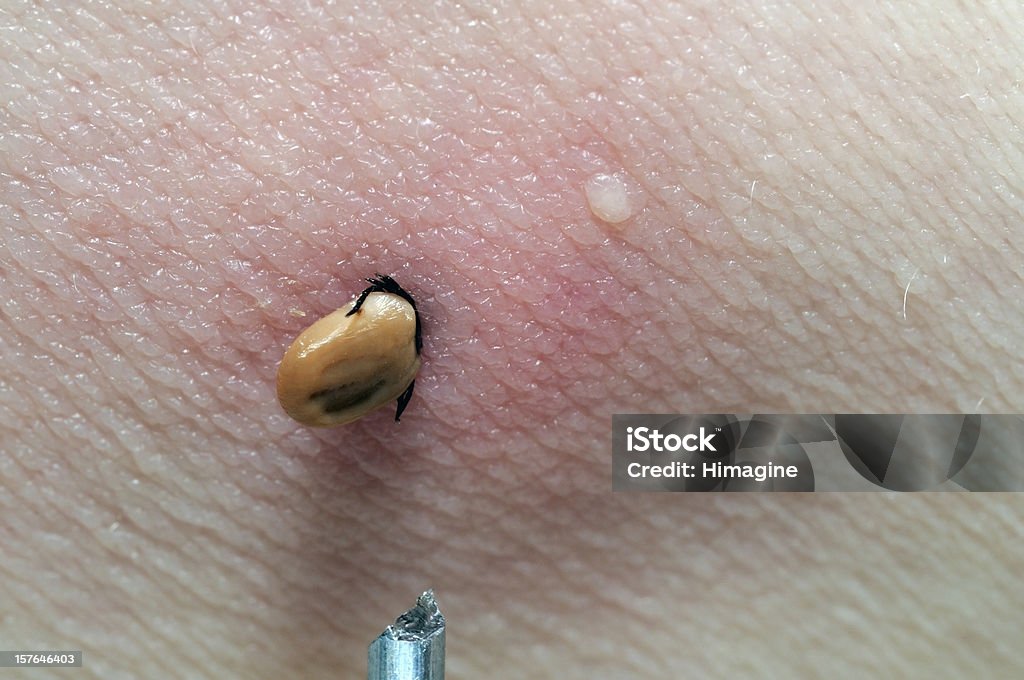 Human tick  Tick - Animal Stock Photo