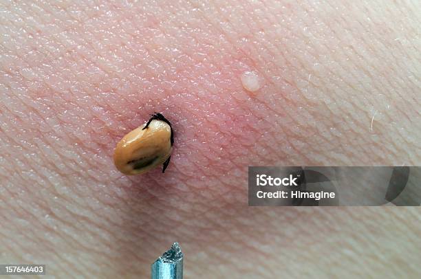 Human Tick Stock Photo - Download Image Now - Tick - Animal, Biting, Lyme Disease