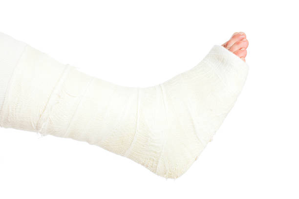 Broken Leg in Cast, Isolated on White Broken Leg in Cast, Isolated on White, XXXL Size broken leg stock pictures, royalty-free photos & images