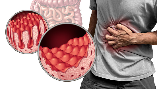 Celiac Disease or coeliac disease as an intestine anatomy medical concept with normal villi and painful damaged small bowel lining as an autoimmune disorder of the digestion system with 3D illustration elements.