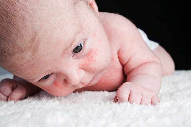 istock Baby Milia skin 157681979