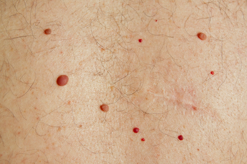 A senior man's back with moles, cysts, cherry angiomas and freckles. Plus a scar from the removal of a cyst .