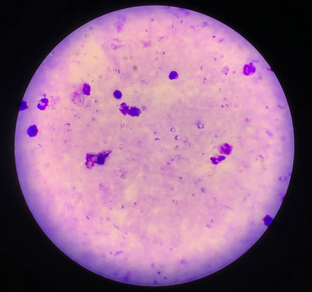 plasmodium falciparum del parassita della malaria su una spessa lettura di striscio di sangue al microscopio - malaria parasite foto e immagini stock