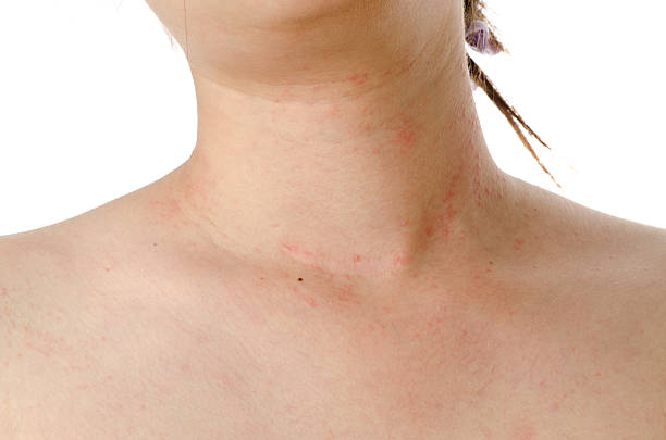 eczema haut am hals - toxicodermatitis stock-fotos und bilder