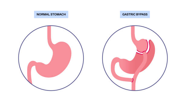 Gastric bypass surgery Gastric bypass gastroplasty stomach operation. Human organs before and after surgery. Obesity problem, weight loss procedure. Abdomen laparoscopy medical poster. Overweight problem vector illustration jejunum stock illustrations