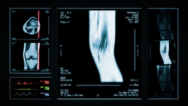 Knee MRI Scan. Top, front and lateral view. Blue.
