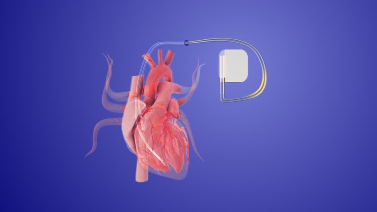 Pacemaker Installation Cath Lab 20+ Cardiac Catheterization Lab Stock Videos and Royalty-Free Footage ...