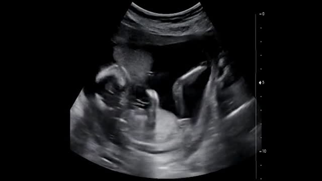 image of an ultrasound exam being performed in a prenatal