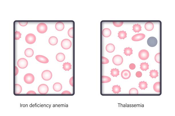 ilustrações, clipart, desenhos animados e ícones de a diferença da anemia ferropriva e talassemia em microscópio de luz. vetor da morfologia sanguínea. - célula alfa