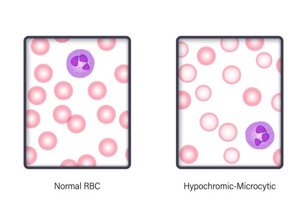 ilustrações, clipart, desenhos animados e ícones de a diferença de hemácias normais e hipocrômico-microcíticas em microscópio de luz. vetor da morfologia sanguínea. - célula alfa