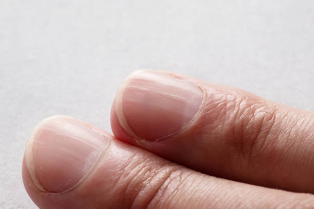 istock Macro photo of vertical ridges in fingernails 1582649816
