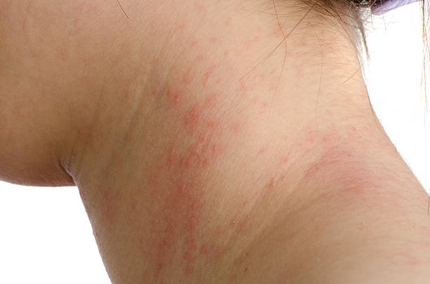 egzema skin na karku - eczema human neck toxicodermatitis close up zdjęcia i obrazy z banku zdjęć
