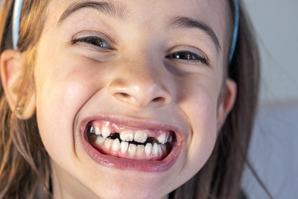 Little happy kid girl at dentist office smiling showing overbite teeth, child during orthodontist visit and oral cavity check-up, children tooth care and hygiene.