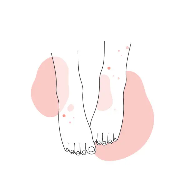 Vector illustration of Human legs with skin allergy