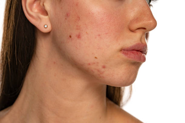 istock Closeup of a female face with problematic skin 1583176998