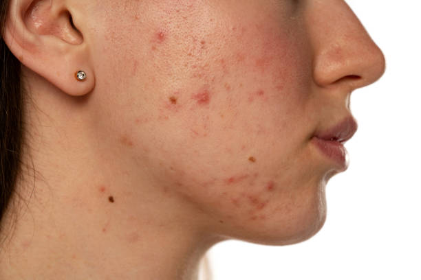 istock Closeup of a female face with problematic skin 1583177004