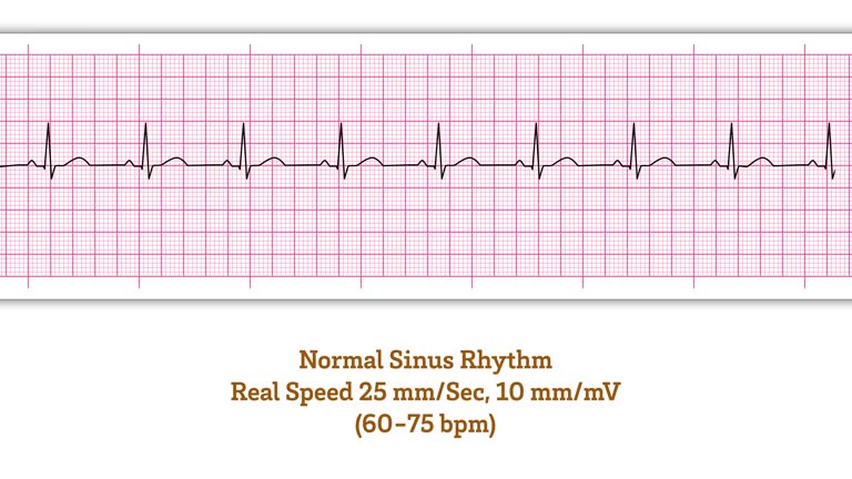 ECG Normal Sinus Rhythm - Animated Electrocardiogram - Real Speed 25 mm/Sec and 10 mm/MV