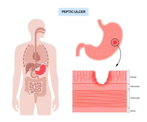 Peptic ulcer disease vector art illustration