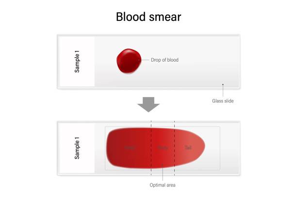 illustrazioni stock, clip art, cartoni animati e icone di tendenza di striscio di sangue per ematologia microscopica. metodo di posizionamento della goccia di campione di sangue sul vetrino. - microscope slide