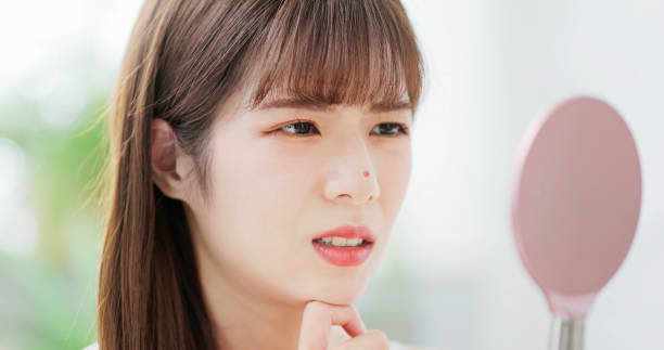 istock woman with pimple 1585180700
