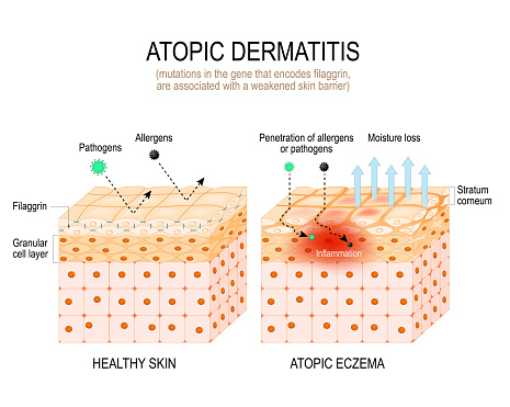 Atopic dermatitis. Filaggrin theory and atopic eczema. mutations in the gene that encodes filaggrin, are associated with a weakened skin barrier. Close-up of cells of Stratum corneum with filament aggregating protein, and cross-section of skin with inflammation. Vector illustration