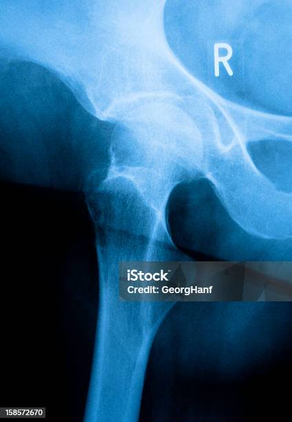 Moda Femmina - Fotografie stock e altre immagini di Osteoporosi - Osteoporosi, Anca, Immagine a raggi X