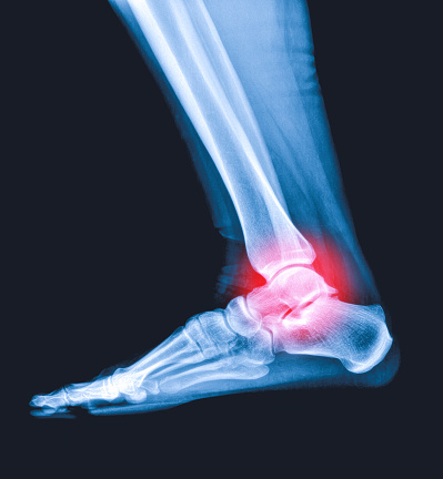X-ray of a human female foot, ankle and lower leg