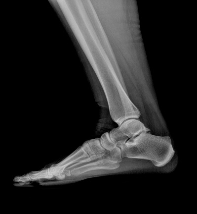 X-ray of a human female foot, ankle and lower leg